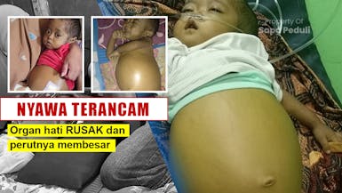 NYAWA TERANCAM! Arfan mengidap penyumbatan saluran empedu, organ hatinya rusak dan perut membesar