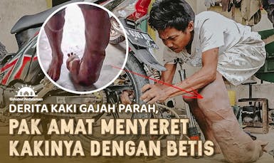 25 Tahun Pak Amat Derita Penyakit Kaki Gajah Parah