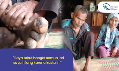 Jari Kaki Digerogoti Kusta, Kek Solihin Tak Bisa Berjalan