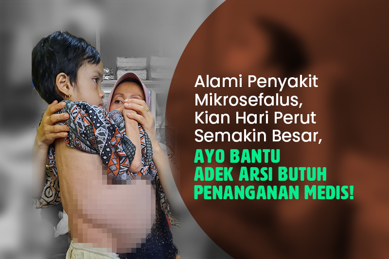 Alami Penyakit Mikrosefalus, Kian Hari Perut Semakin Besar, Adek Arsi Butuh Penanganan Medis