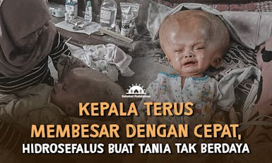 Jangan Sampai Pengobatan Hidrosefalus Tania Tertunda!