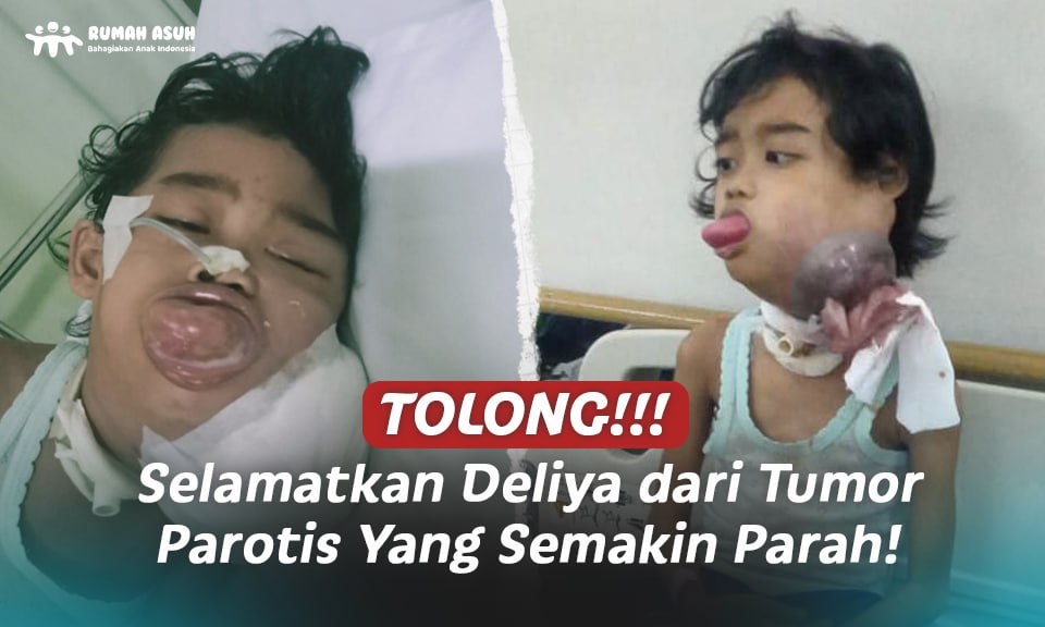Keselamatan Semakin Terancam, Selamatkan Deliya Dari Tumor Parotis!