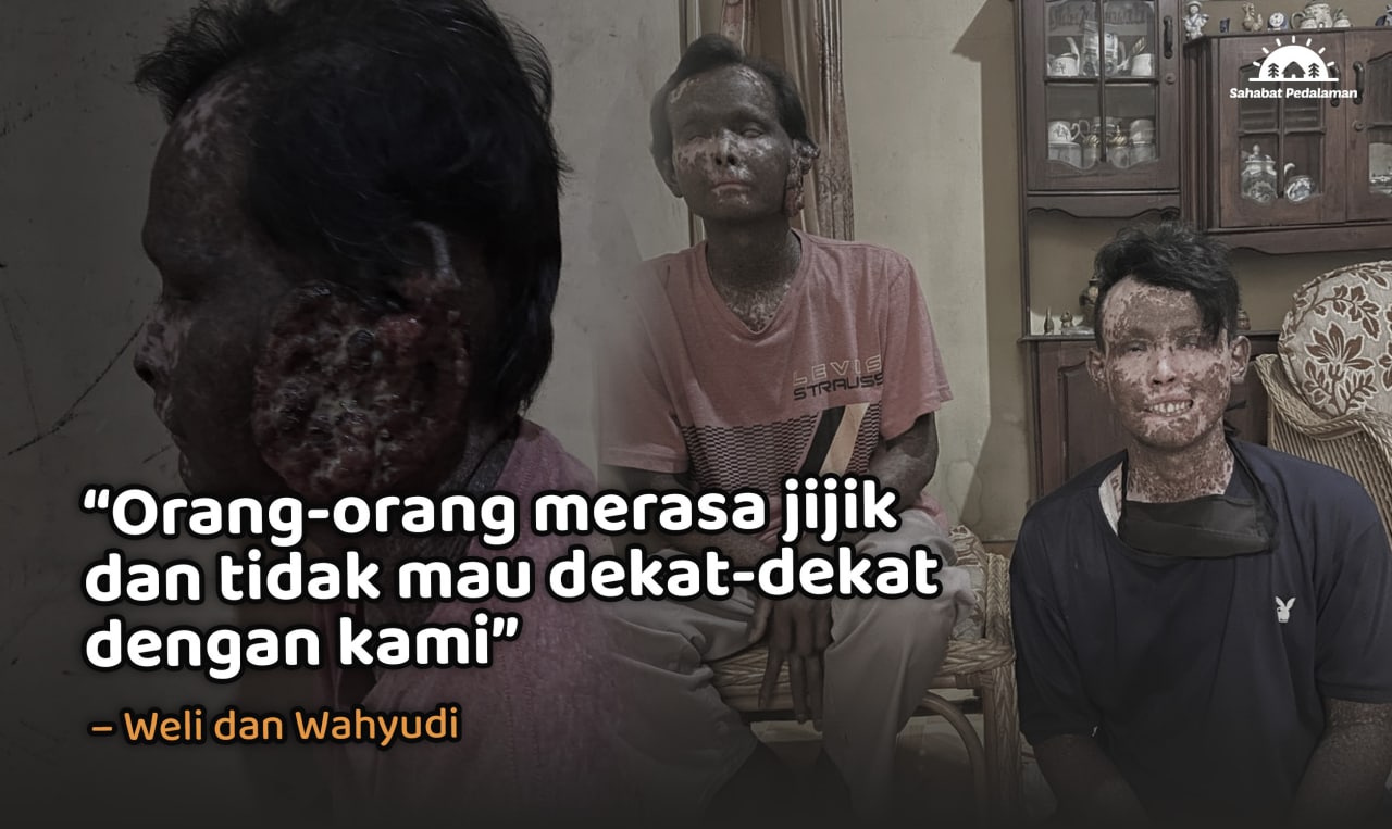 Dijauhi Tetangga, Bantu Weli dan Wahyudi Sembuh dari Kelainan Kulit