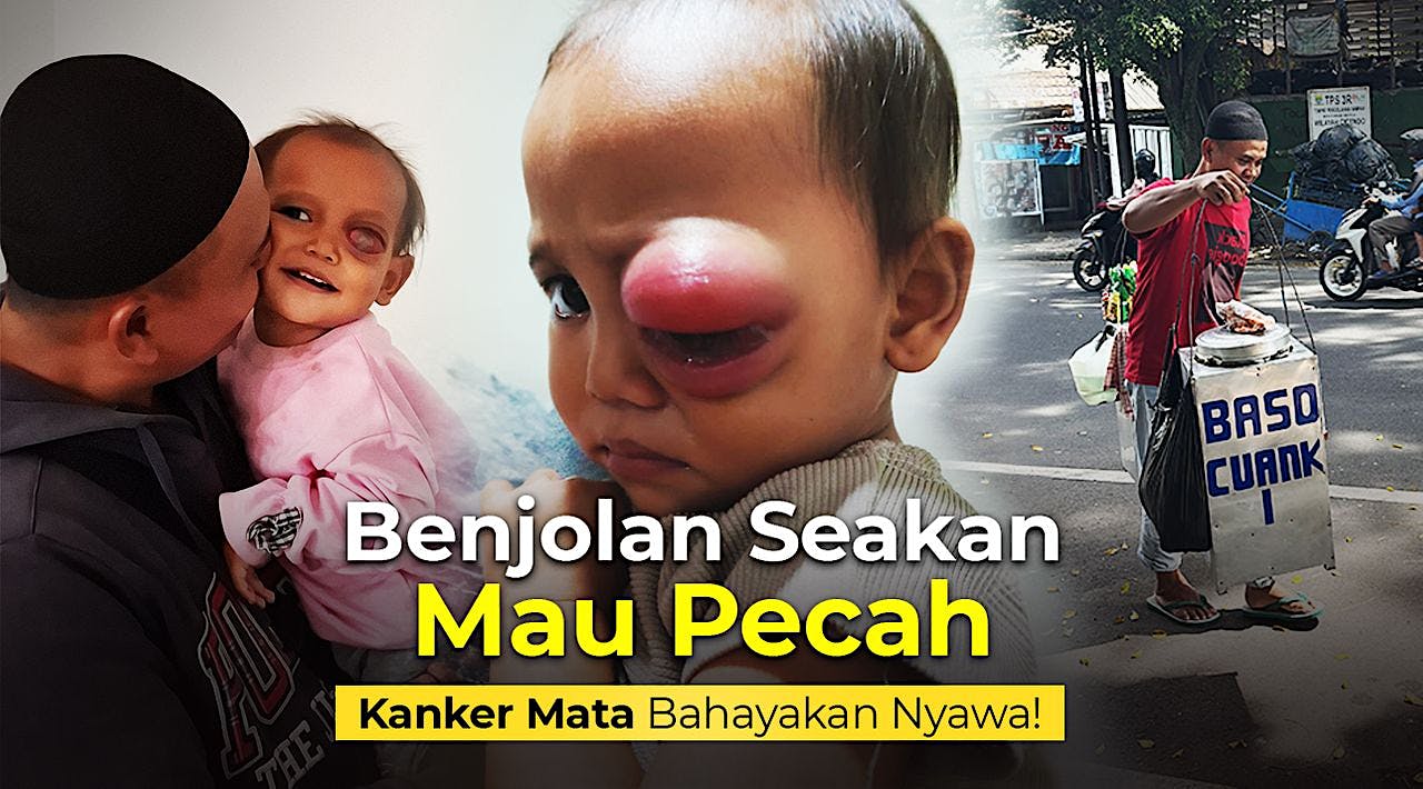 TOLONG! Bantu Bayi Melawan Kanker Mata
