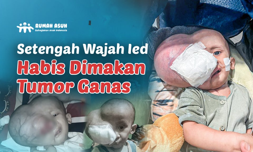 Tolong Selamatkan Ied dari Tumor Ganas yang Menyerang Wajahnya!