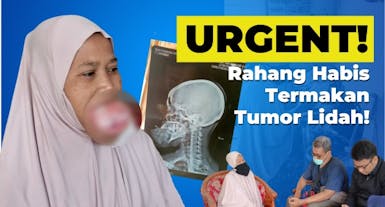 URGENT! Rahang Hampir Habis Termakan Tumor