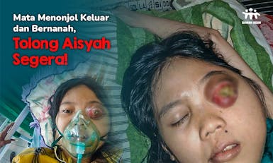 Urgent! Bola Mata Aisyah Menonjol dan Bernanah Karena Tumor