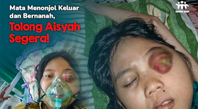Urgent! Bola Mata Aisyah Menonjol dan Bernanah Karena Tumor