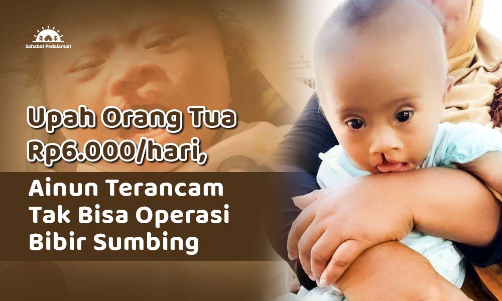 Bantu Ainun, Bayi Dengan Kelainan Bibir Sumbing