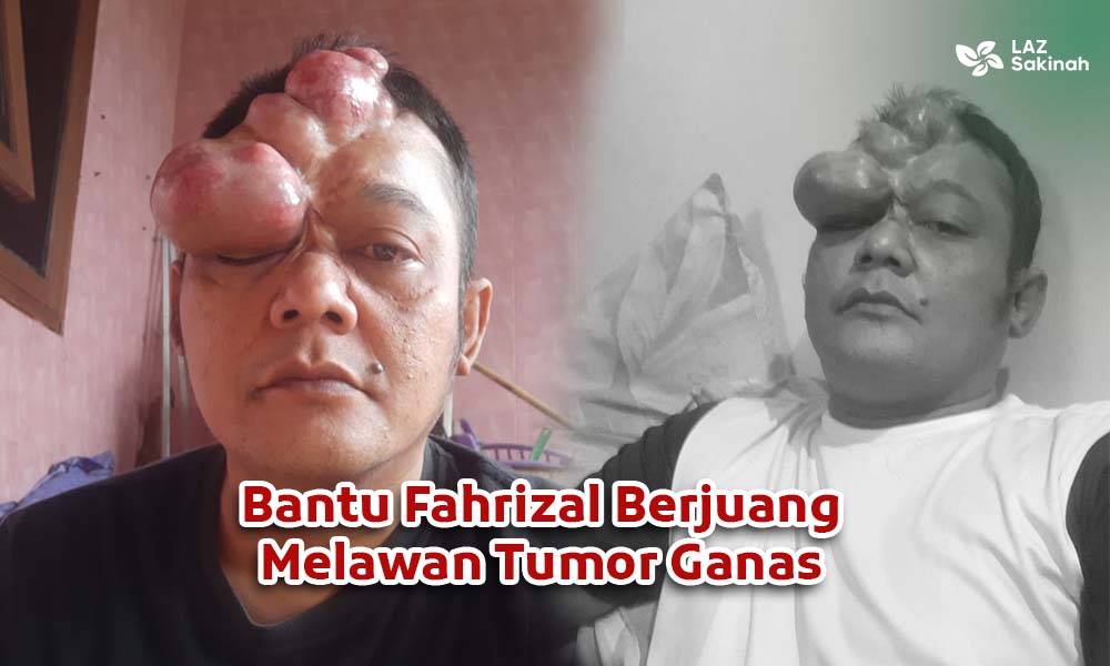 Bantu Fahrizal Sembuh dari Tumor Ganas