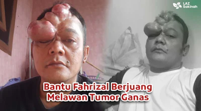 Bantu Fahrizal Sembuh dari Tumor Ganas