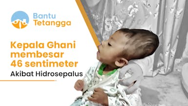 Segera Bantu! Kepala Dik Ghani (2 th) Membesar karena Hidrosepalus